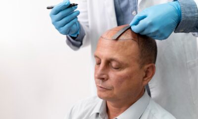 Hair Transplant