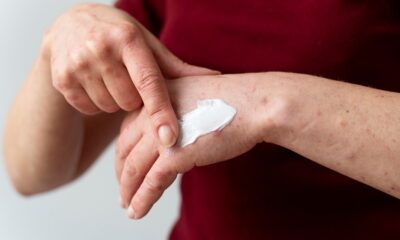 Eczema Creams